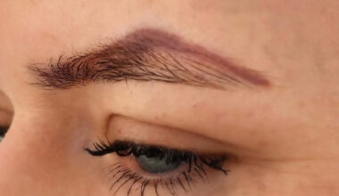 What to Expect From Cosmetic Tattoo Removal