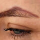 What to Expect From Cosmetic Tattoo Removal