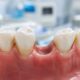 How Rockville MD Residents Can Compare Tooth Replacement Options Before Making a Long Term Decision