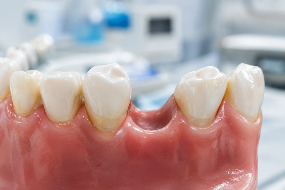 How Rockville MD Residents Can Compare Tooth Replacement Options Before Making a Long Term Decision