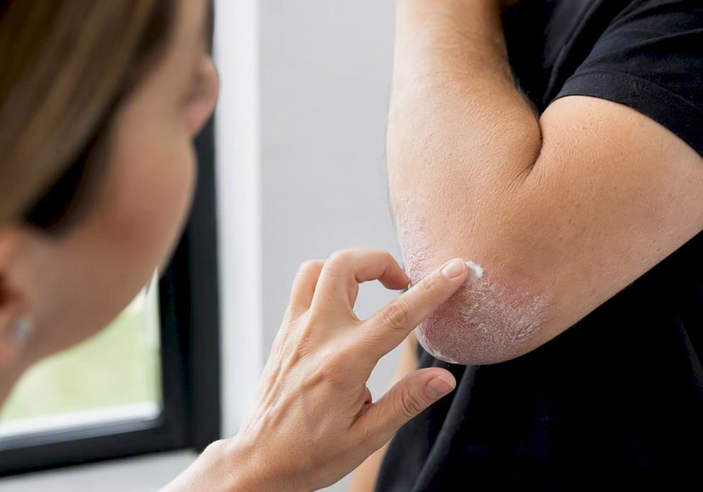 Plaque Psoriasis on the Elbows